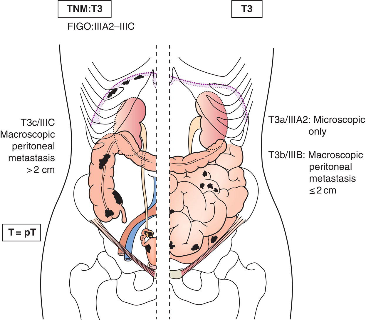 Schematic illustration of Microscopic extrapelvic peritoneal involvement with or without retroperitoneal lymph node, including bowel involvement.