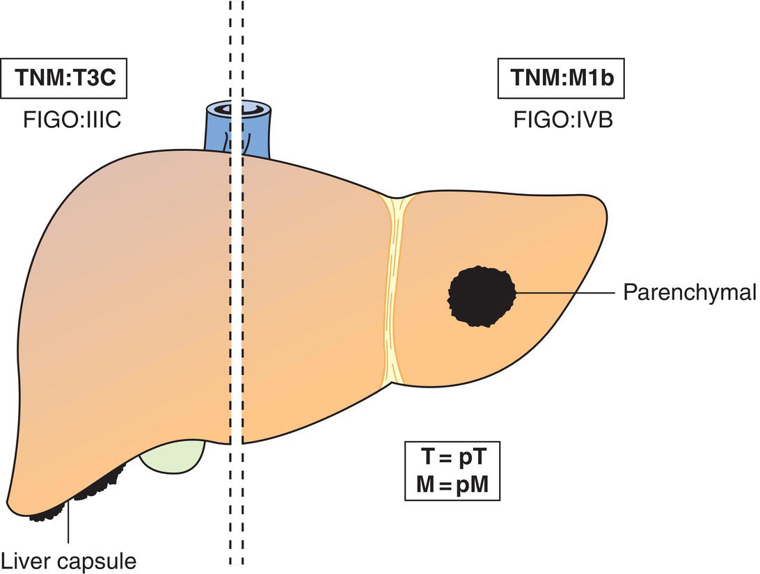 Schematic illustration of Peritoneal metastasis beyond pelvic brim more than 2 cm in greatest dimension and retroperitoneal lymph node metastasis.