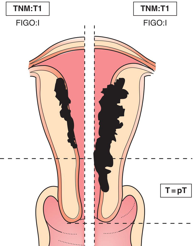 Schematic illustration of tumour confined to the uterus.