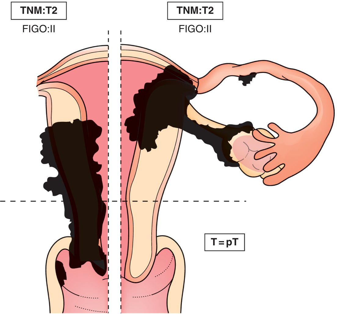 Schematic illustration of tumour extends to other genital structures: vagina, ovary, broad ligament, fallopian tube(s), by direct extension or metastasis.