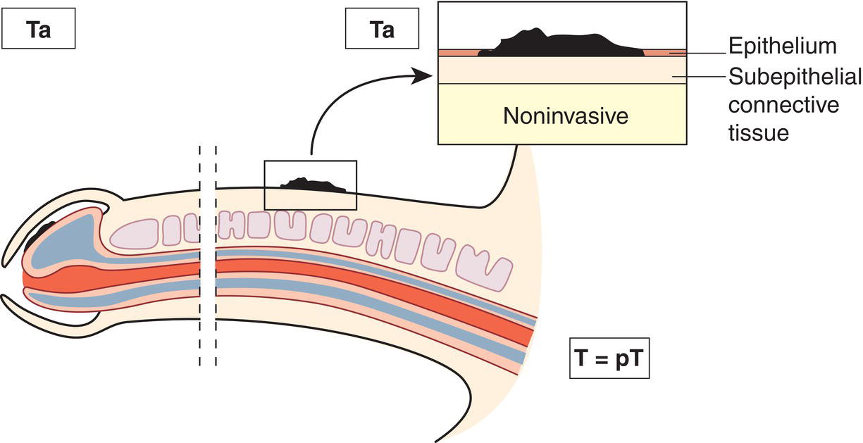 Schematic illustration of Noninvasive localized squamous cell carcinoma.