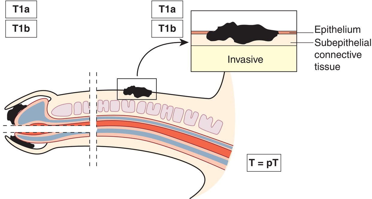 Schematic illustration of tumour invades subepithelial connective tissue.