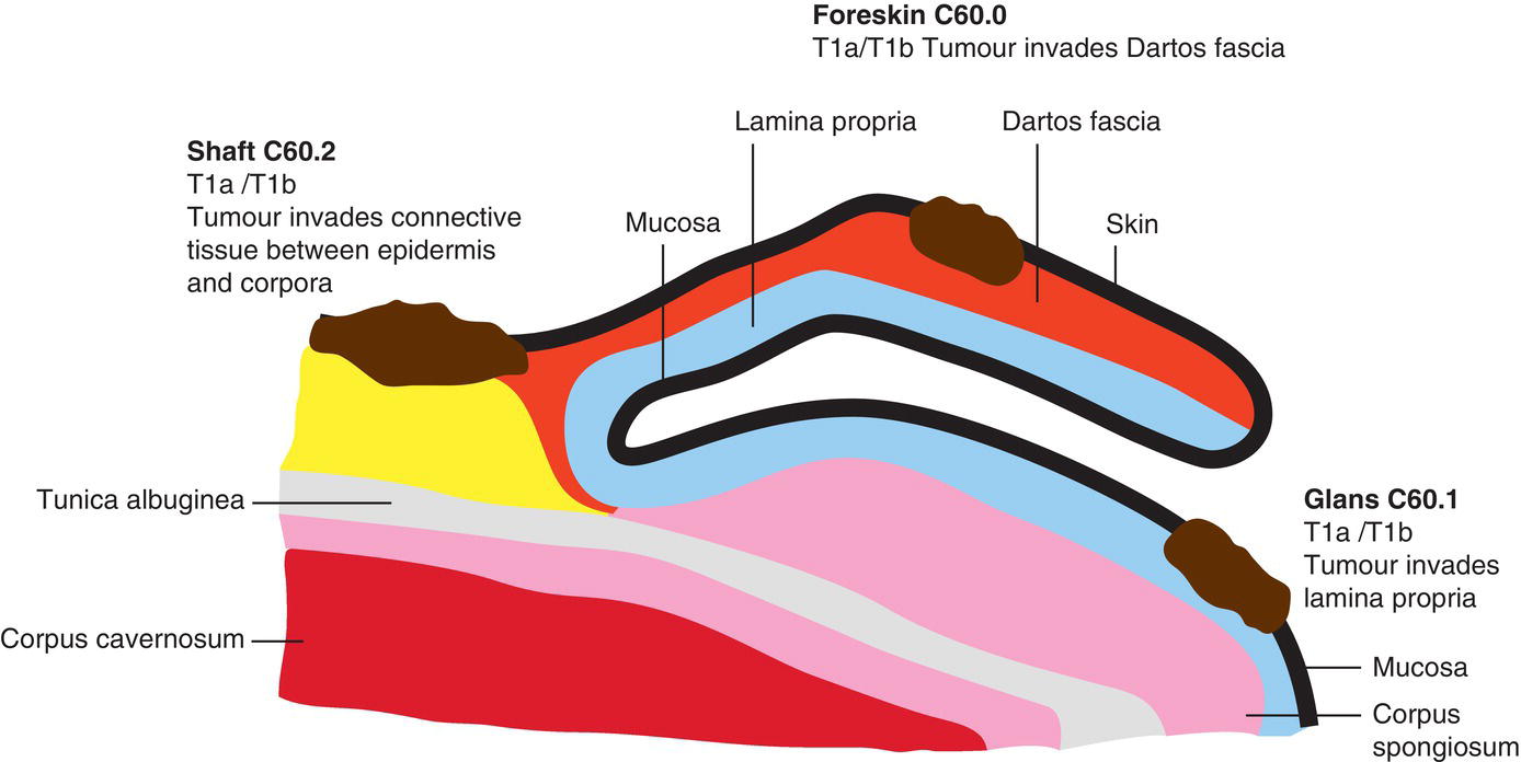 Schematic illustration of tumour invades subepithelial connective tissue with lymphovascular invasion or perineural invasion or is poorly differentiated.