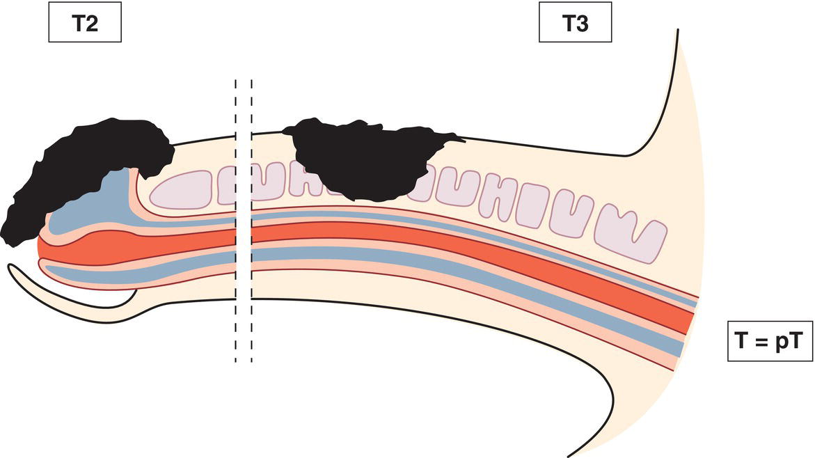 Schematic illustration of tumour invades corpus spongiosum with or without invasion of the urethra.