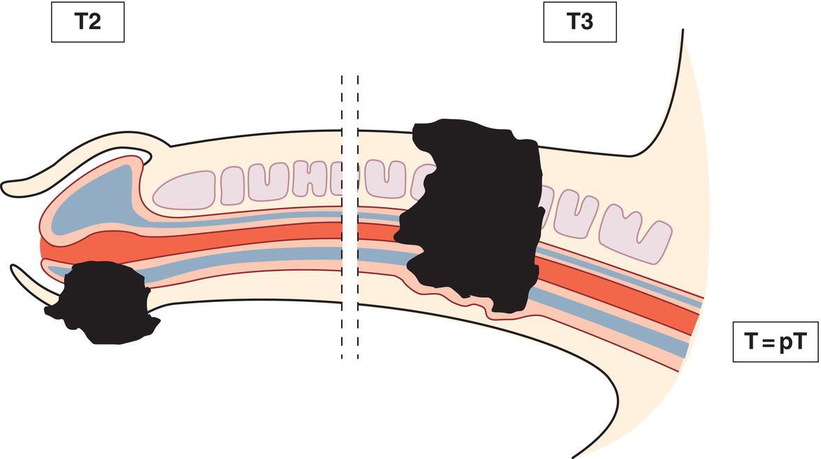 Schematic illustration of tumour invades corpus spongiosum with or without invasion of the urethra.