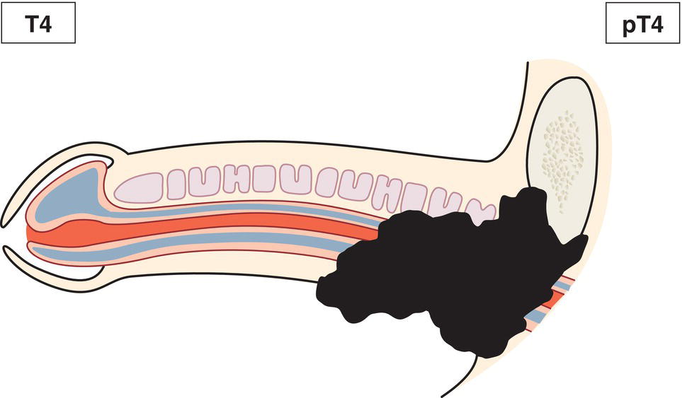 Schematic illustration of tumour invades other adjacent structures.