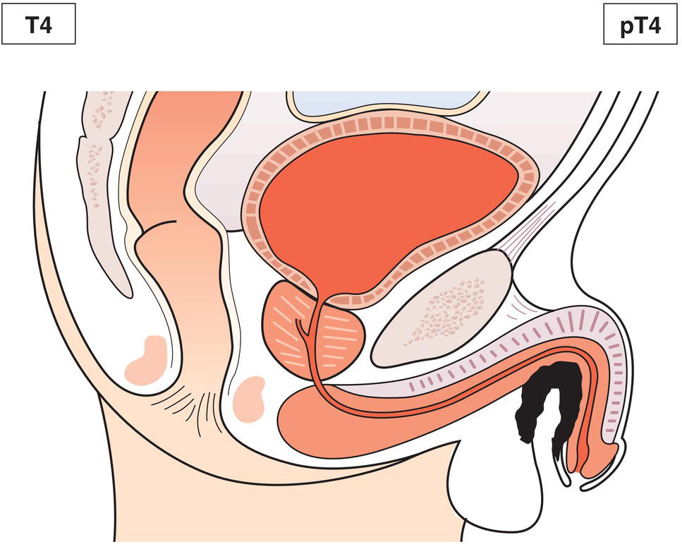 Schematic illustration of tumour invades other adjacent structures.