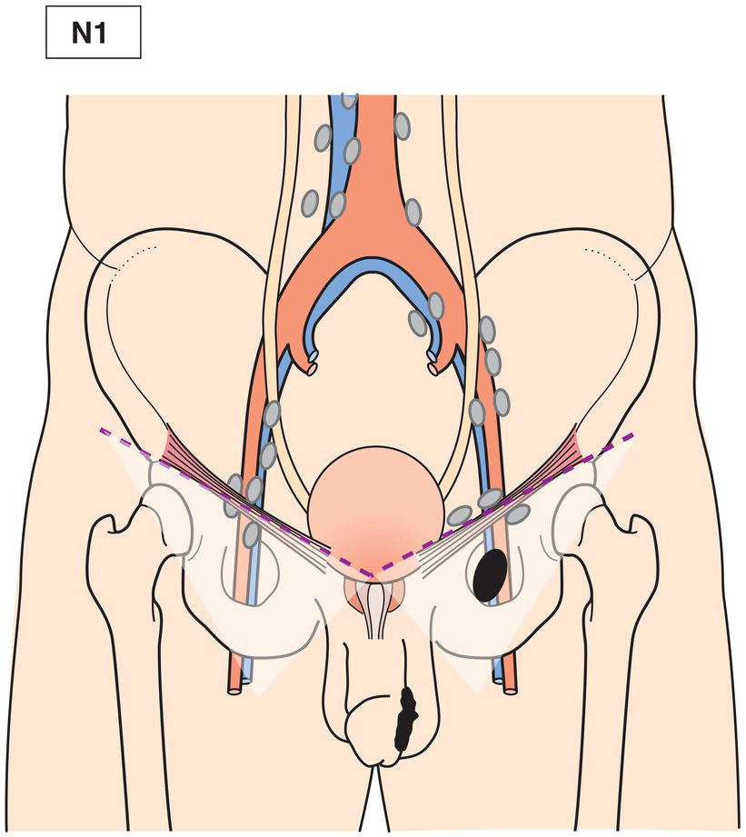 Schematic illustration of Palpable mobile unilateral inguinal lymph node.