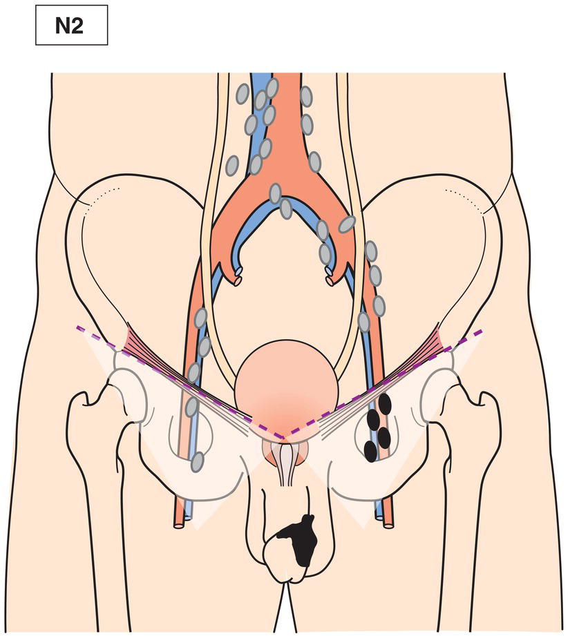 Schematic illustration of Palpable mobile multiple.