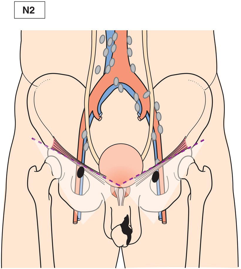 Schematic illustration of bilateral inguinal lymph nodes.