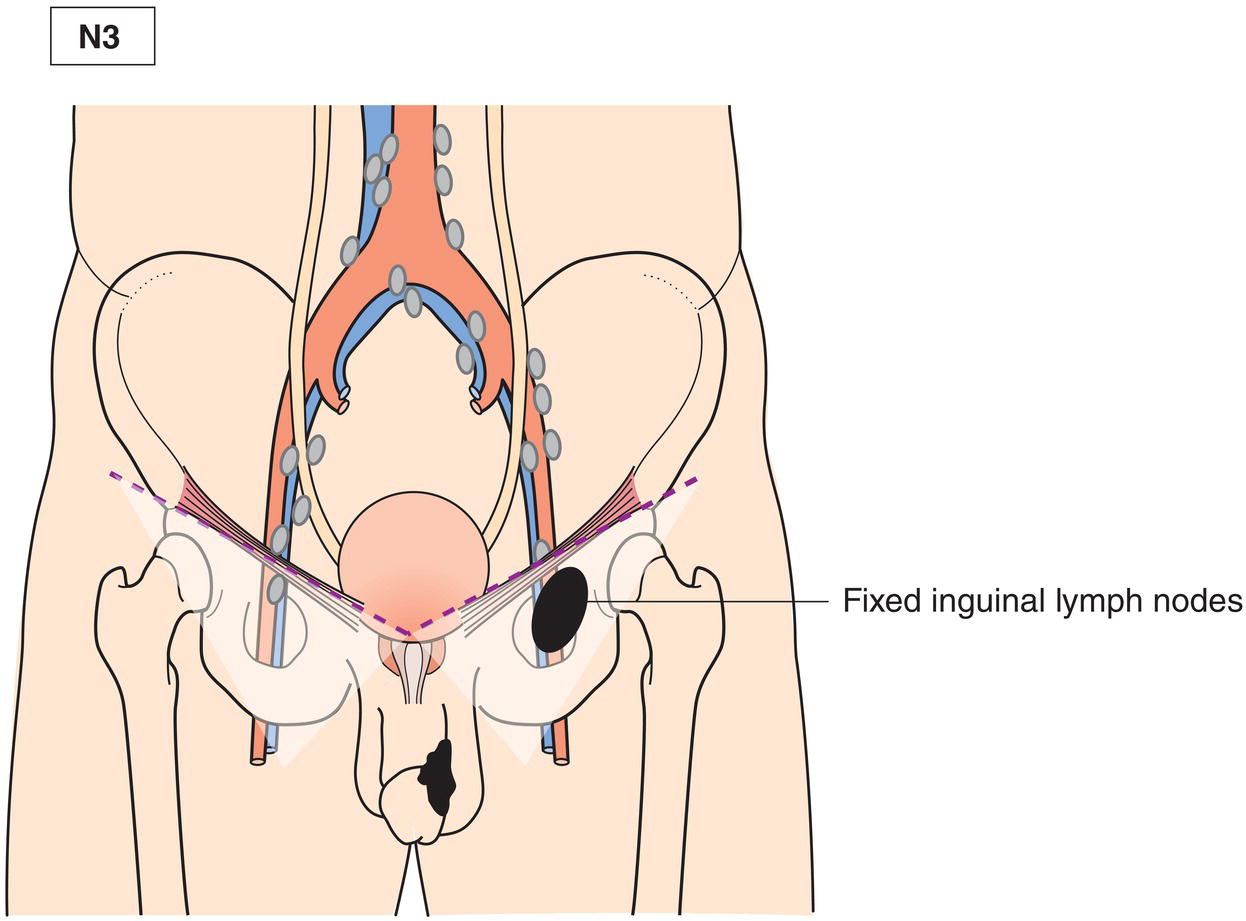 Schematic illustration of Fixed inguinal nodal mass.