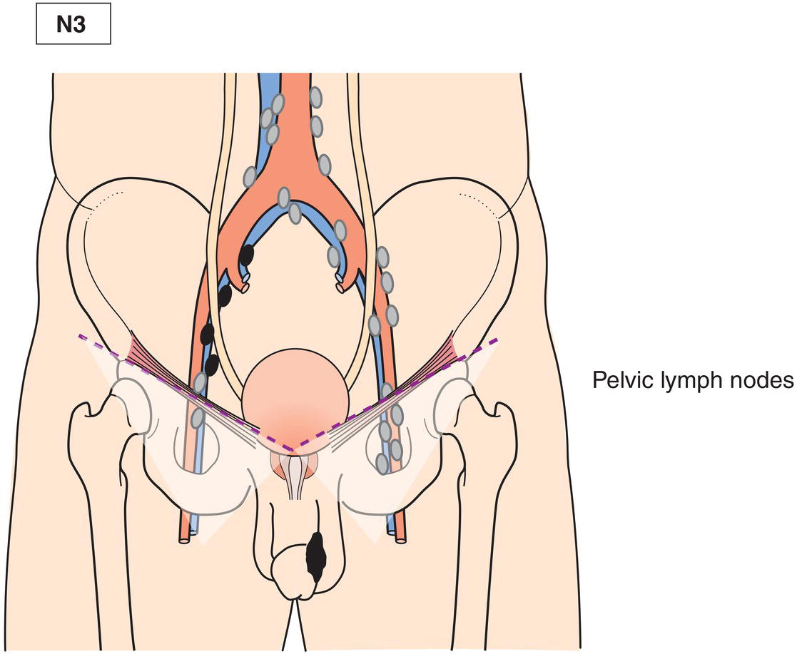 Schematic illustration of pelvic lymphadenopathy unilateral.