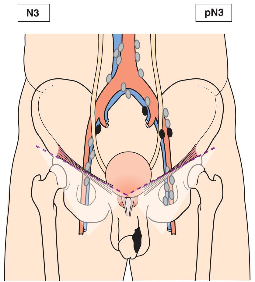 Schematic illustration of bilateral.