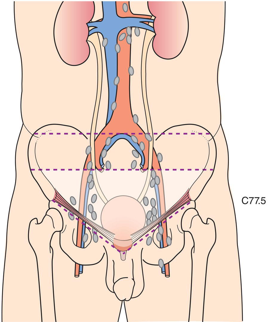 Schematic illustration of The regional lymph nodes are the nodes of the true pelvis, which essentially are the pelvic
nodes below the bifurcation of the common iliac arteries.