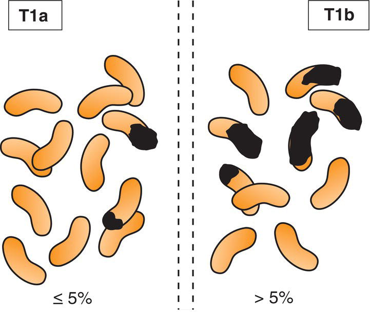 Schematic illustration of Clinically inapparent tumour that is not palpable.