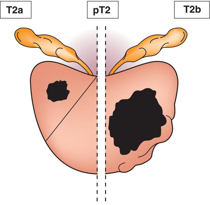 Schematic illustration of tumour involves one half of one lobe or less.