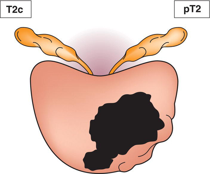 Schematic illustration of tumour involves both lobes.