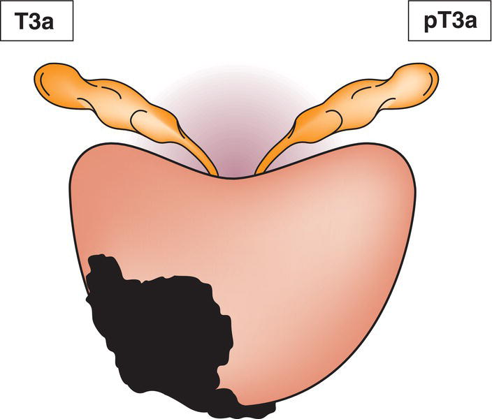 Schematic illustration of Extraprostatic extension (unilateral or bilateral) including microscopic bladder neck involvement.