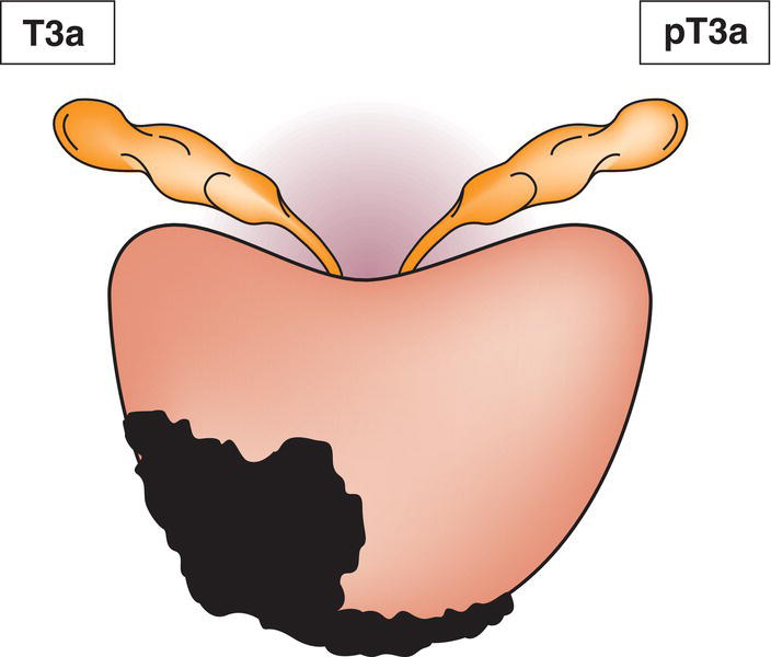 Schematic illustration of Extraprostatic extension (unilateral or bilateral) including microscopic bladder neck involvement.