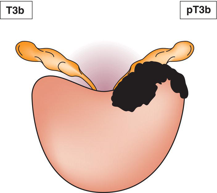 Schematic illustration of tumour invades seminal vesicle(s).