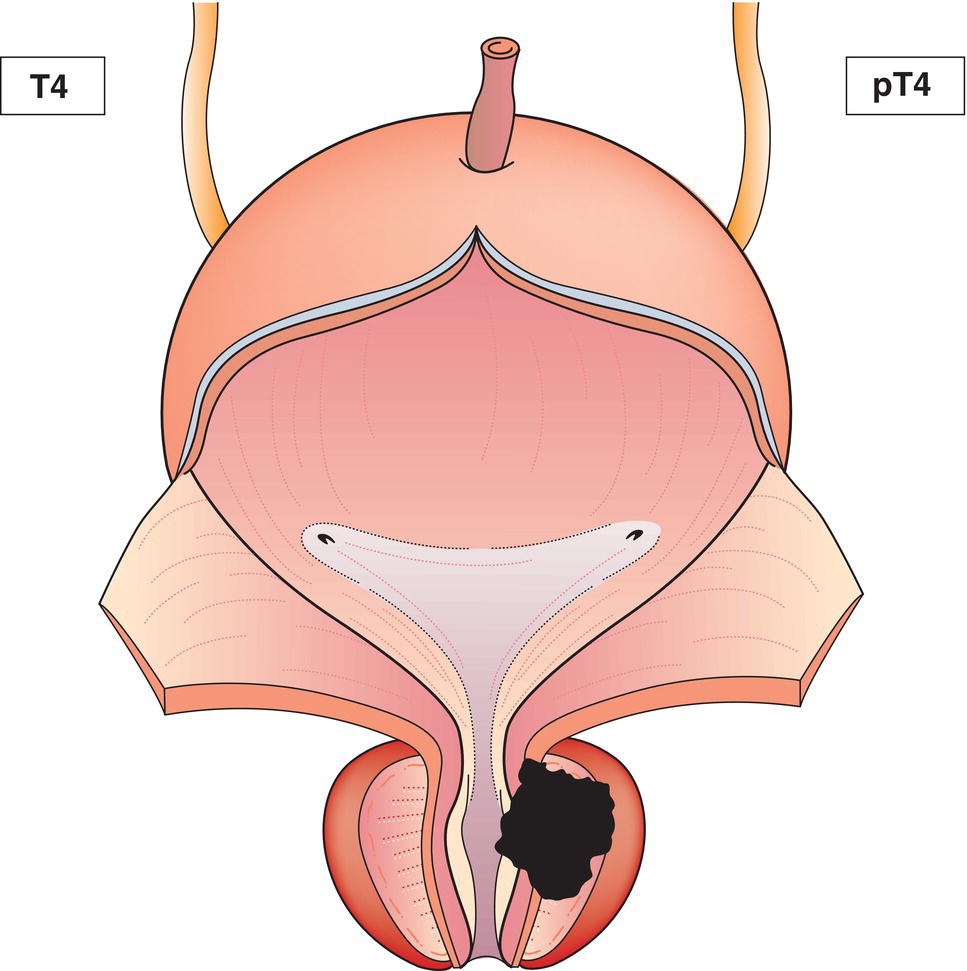 Schematic illustration of tumour is fixed or invades adjacent structures other than seminal vesicles: bladder neck, external sphincter, rectum, levator muscles, and pelvic wall.