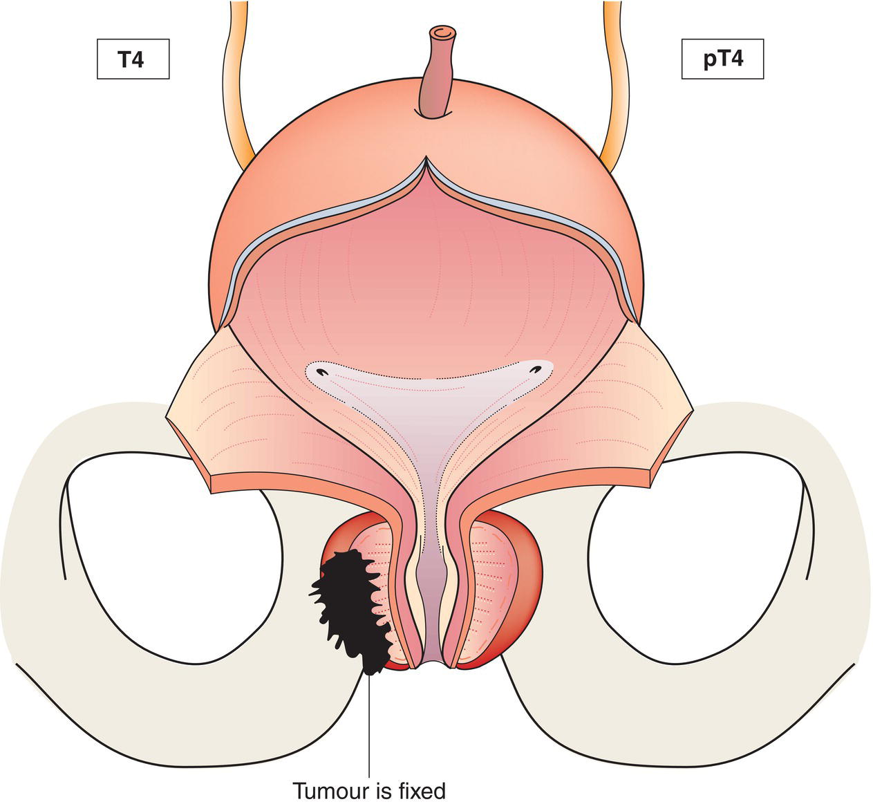 Schematic illustration of tumour is fixed or invades adjacent structures other than seminal vesicles: bladder neck, external sphincter, rectum, levator muscles, and pelvic wall.