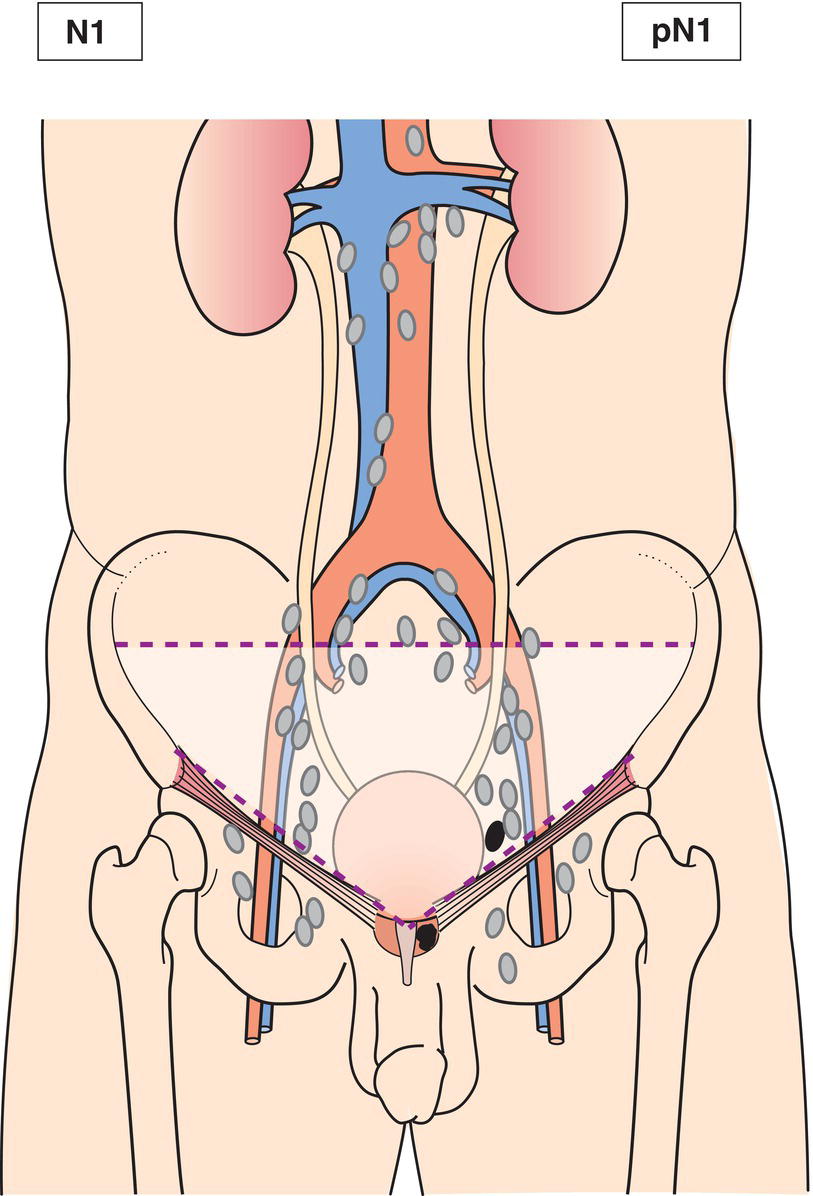 Schematic illustration of Regional lymph node metastasis.