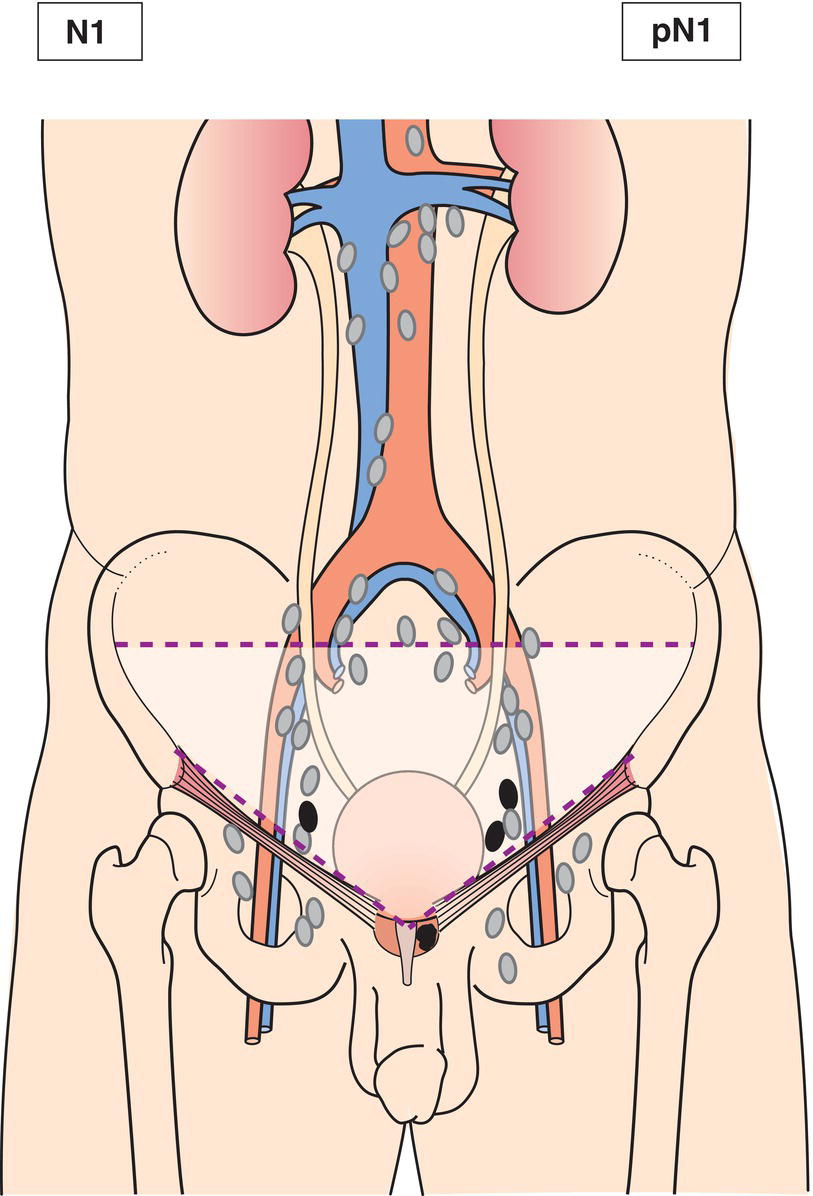 Schematic illustration of Regional lymph node metastasis.