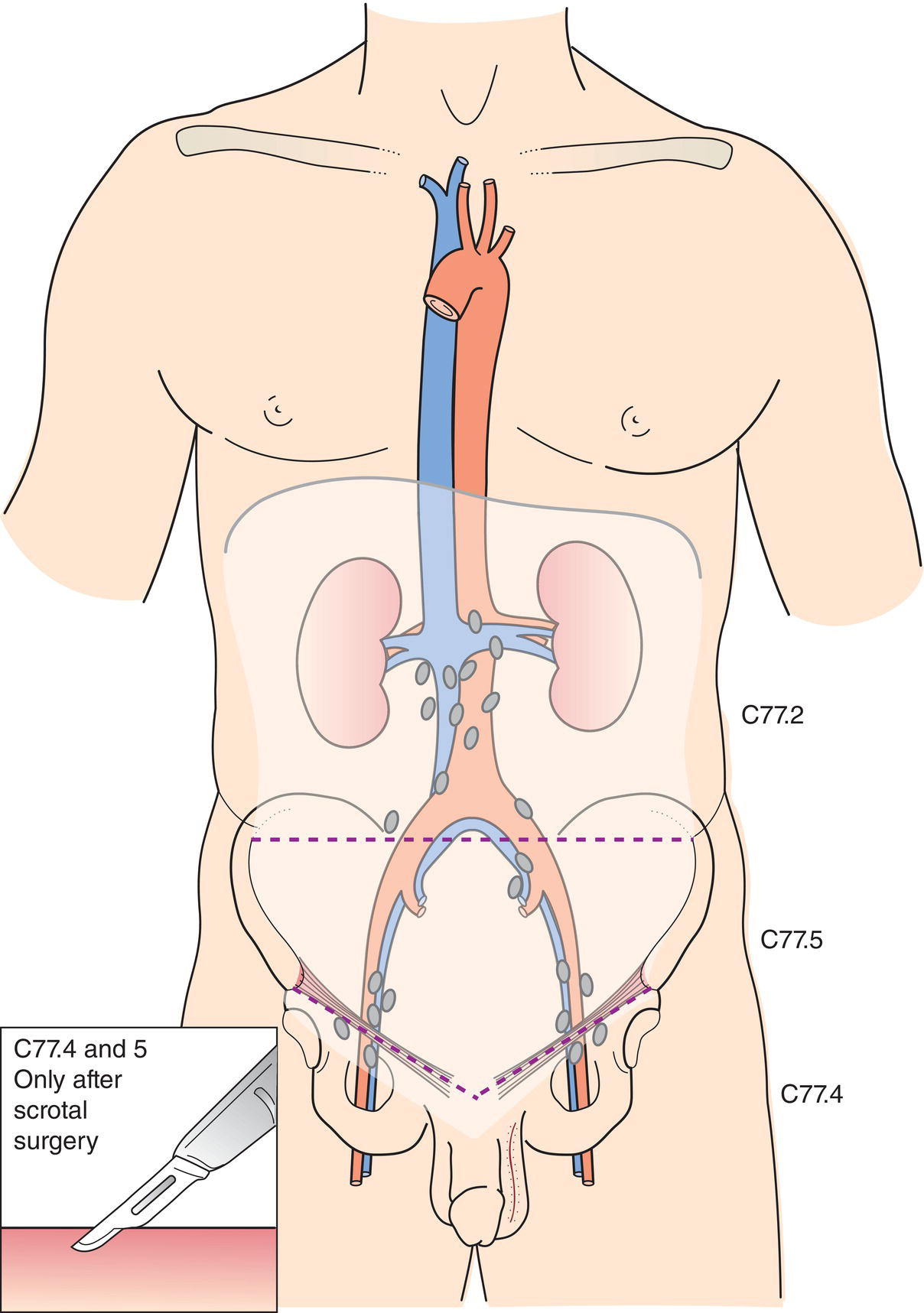 Schematic illustration of The regional lymph nodes are the abdominal para-aortic (periaortic), preaortic, interaortocaval, precaval, paracaval, retrocaval, and retroaortic nodes.