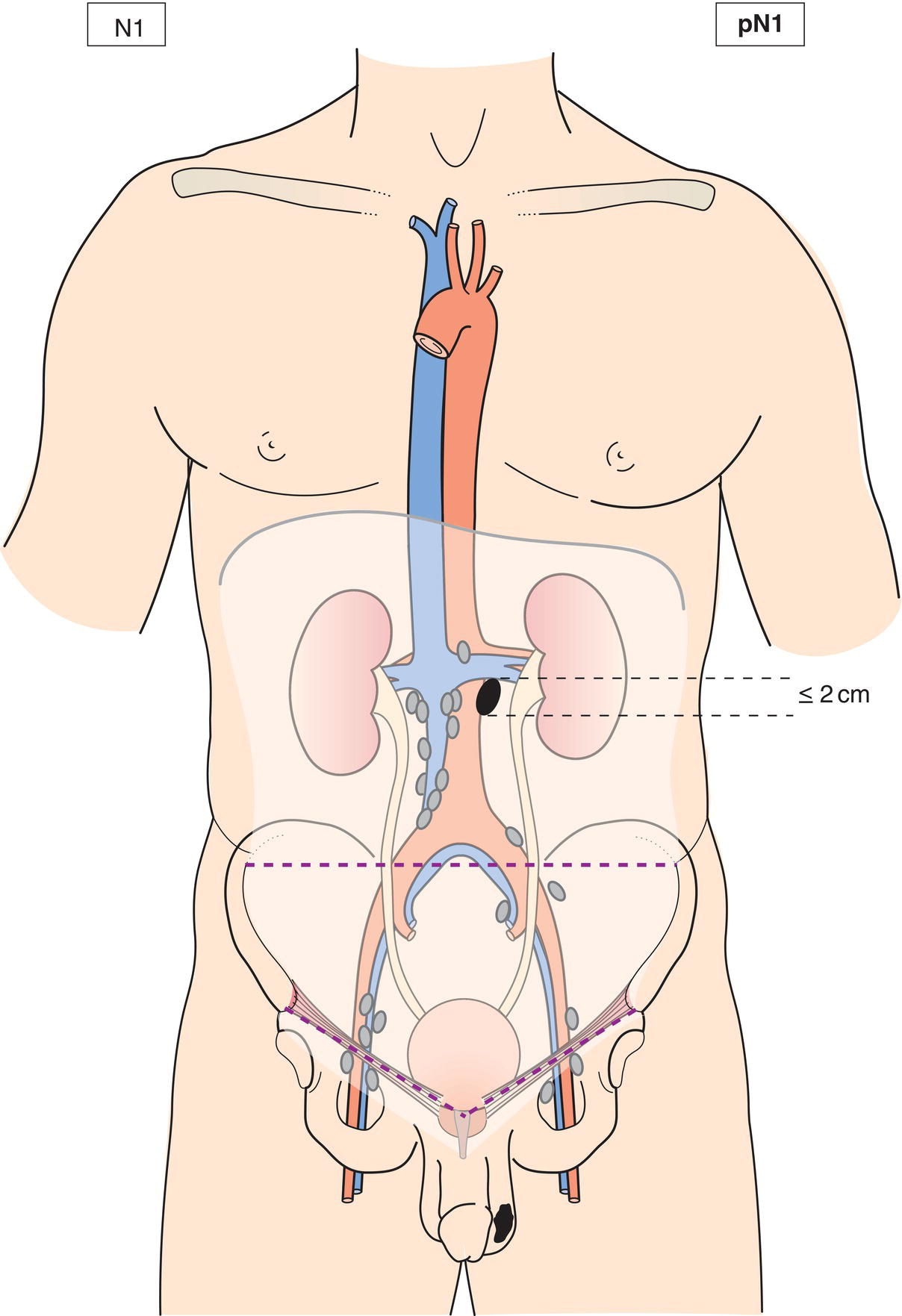 Schematic illustration of Metastasis with a lymph node mass 2 cm or less in greatest dimension or multiple lymph nodes, none more than 2 cm in greatest dimension.