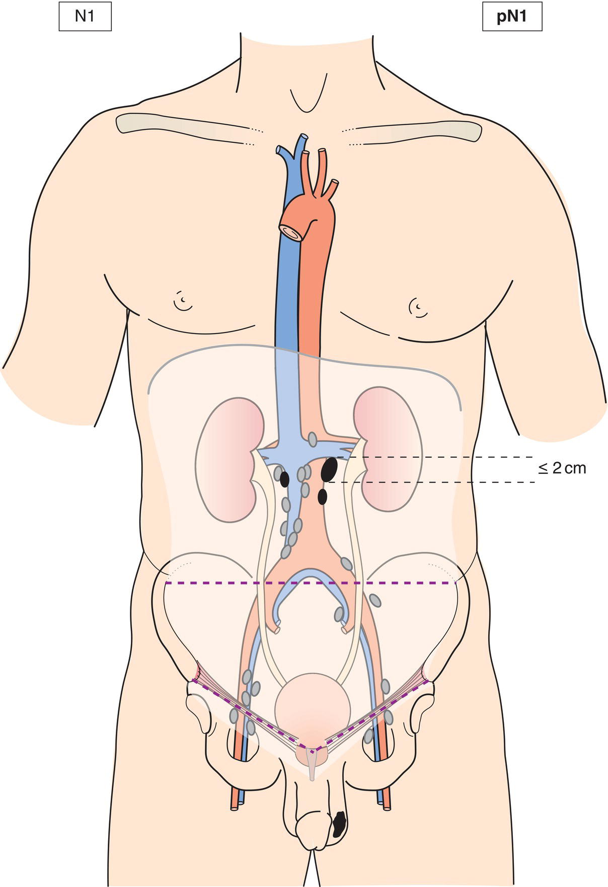 Schematic illustration of Metastasis with a lymph node mass 2 cm or less in greatest dimension or multiple lymph nodes, none more than 2 cm in greatest dimension.