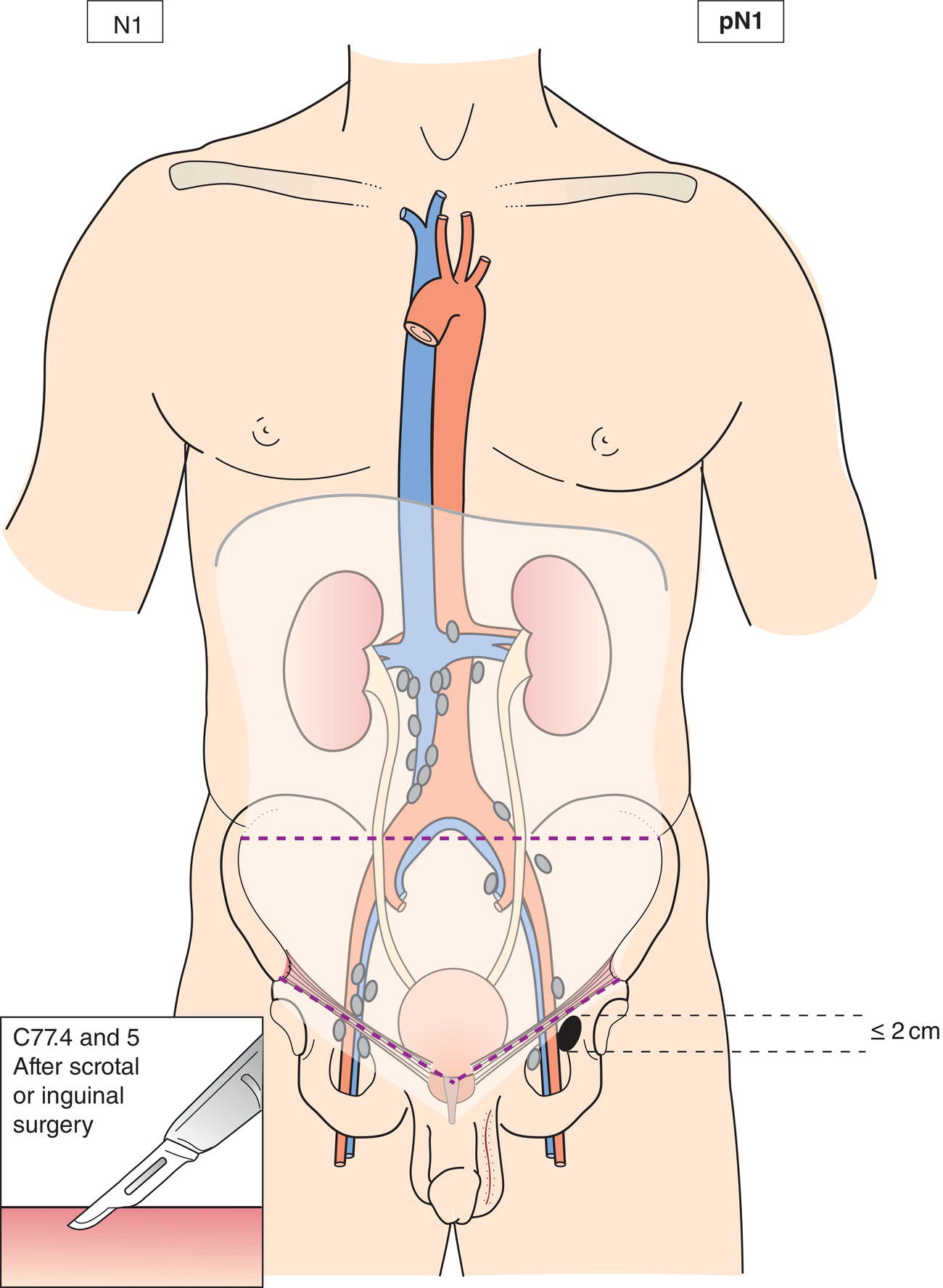 Schematic illustration of Metastasis with a lymph node mass 2 cm or less in greatest dimension or multiple lymph nodes, none more than 2 cm in greatest dimension.