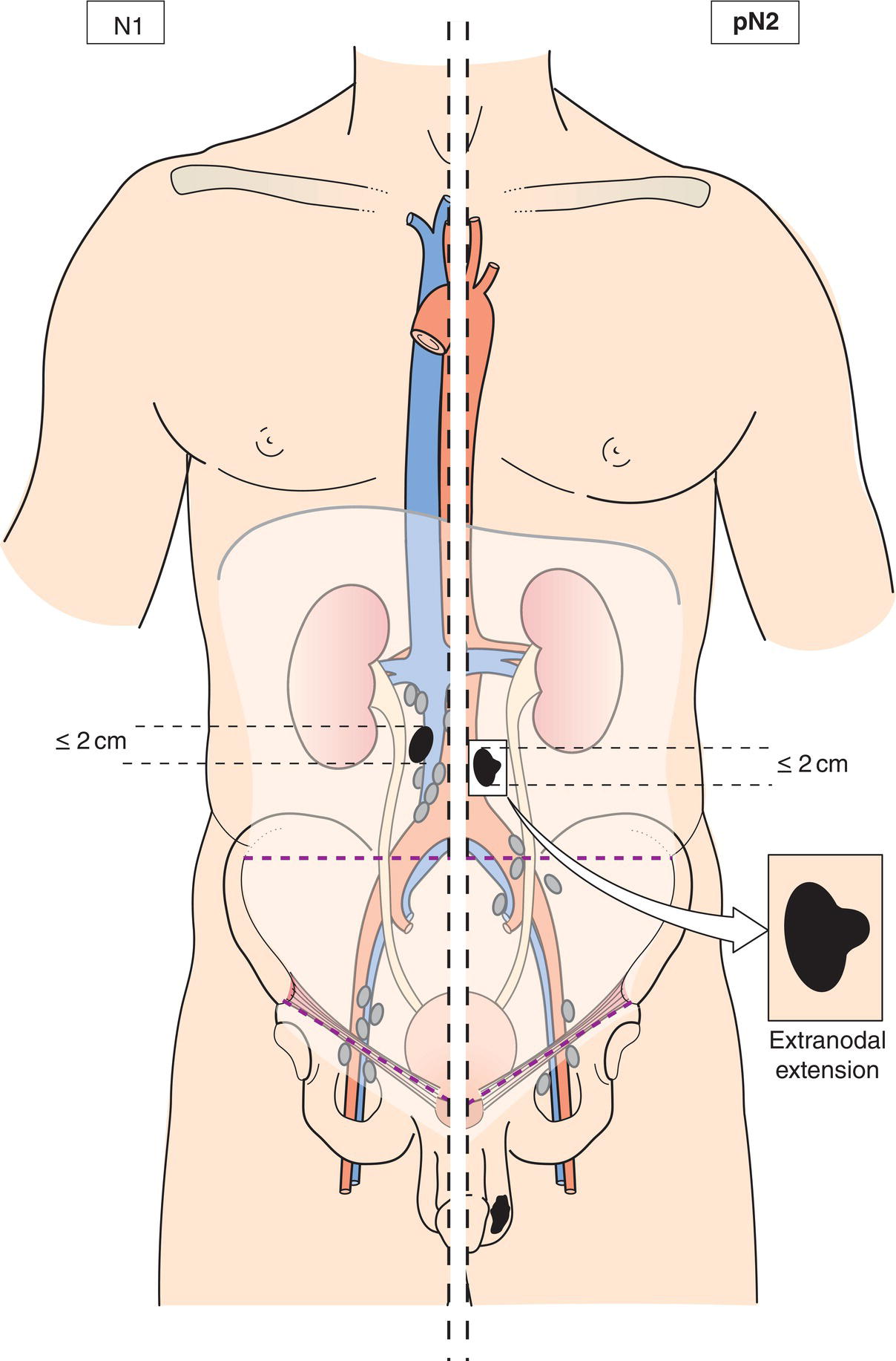 Schematic illustration of Metastasis with a lymph node mass 2 cm or less in greatest dimension or multiple lymph nodes, none more than 2 cm in greatest dimension.