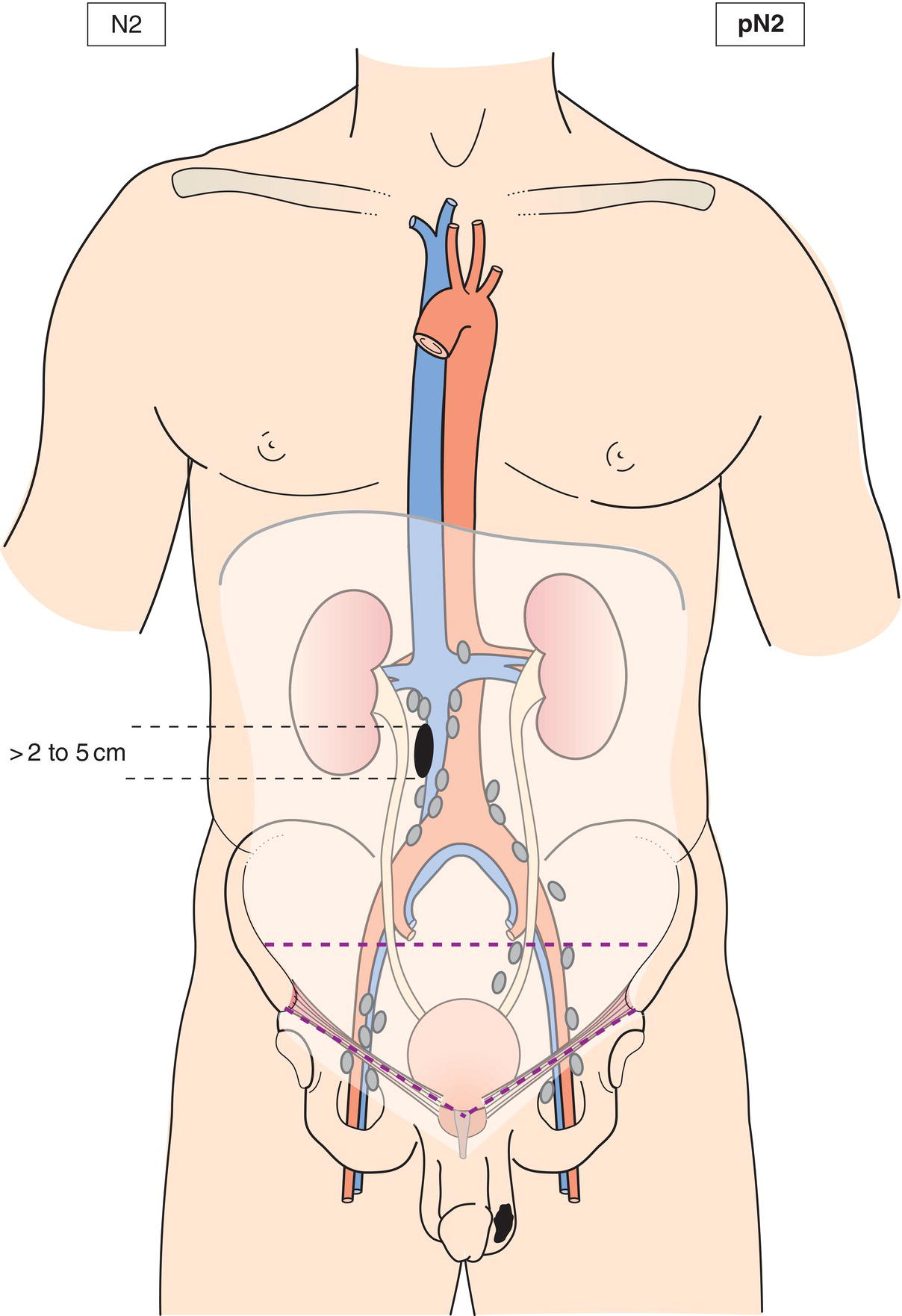 Schematic illustration of Metastasis with a lymph node mass more than 2 cm but not more than 5 cm in greatest dimension, or multiple lymph nodes, any one mass more than 2 cm but not more than 5 cm in greatest dimension.