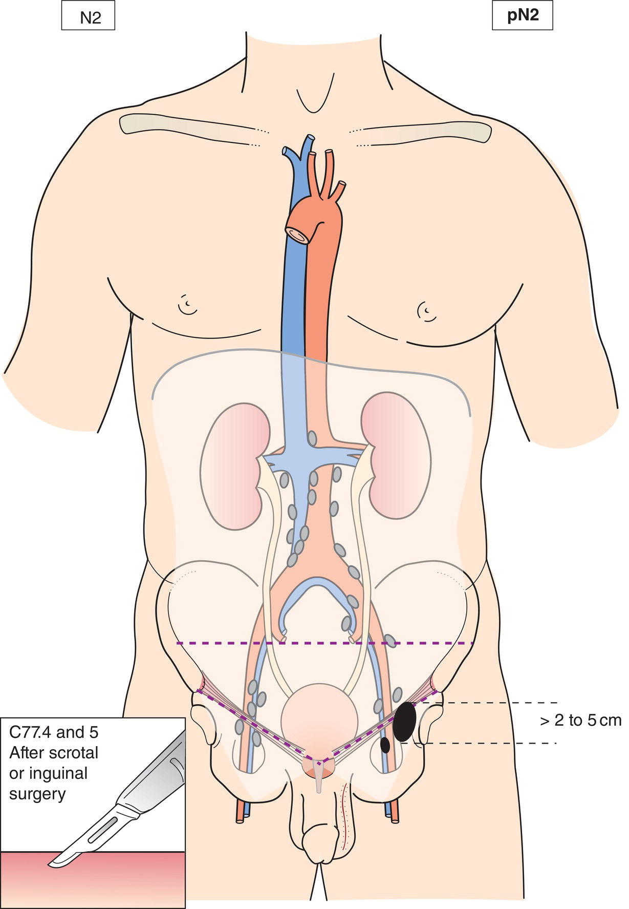 Schematic illustration of Metastasis with a lymph node mass more than 2 cm but not more than 5 cm in greatest dimension, or multiple lymph nodes, any one mass more than 2 cm but not more than 5 cm in greatest dimension.