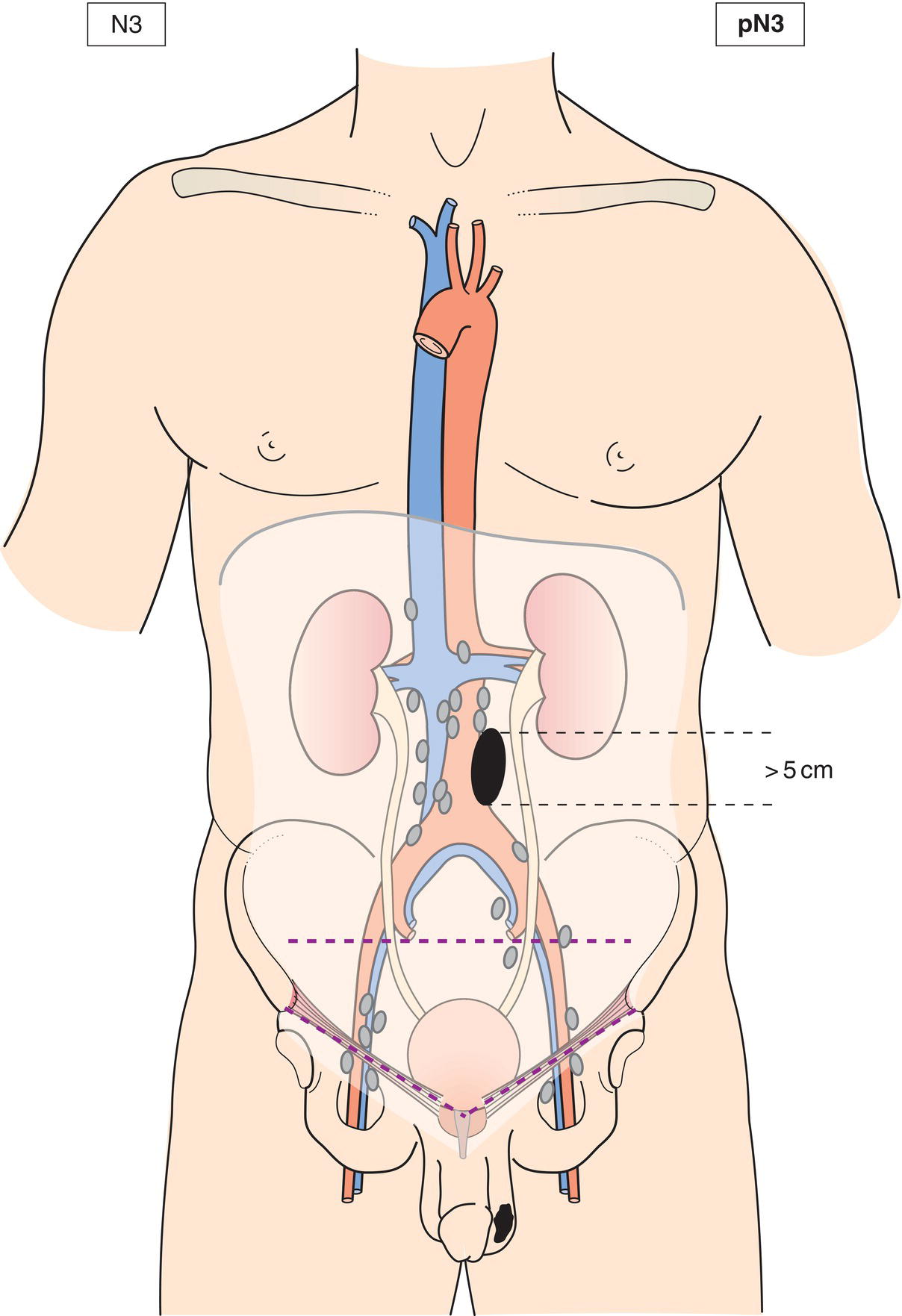 Schematic illustration of Metastasis with a lymph node mass more than 5 cm in greatest dimension.