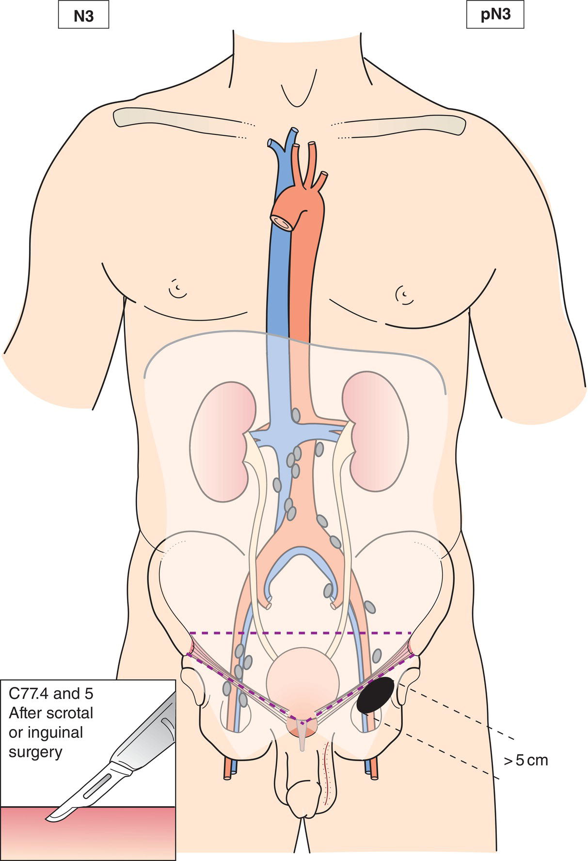 Schematic illustration of Metastasis with a lymph node mass more than 5 cm in greatest dimension.