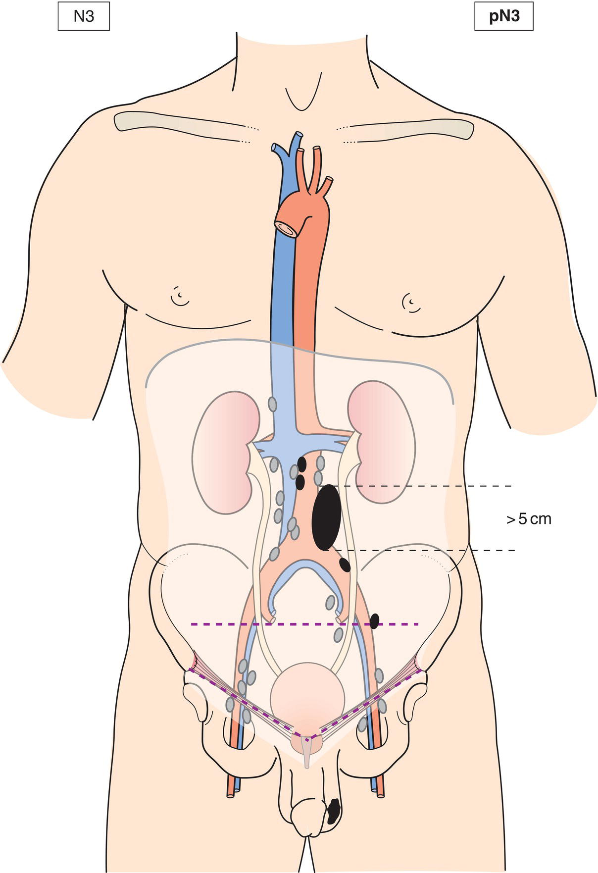 Schematic illustration of Metastasis with a lymph node mass more than 5 cm in greatest dimension.