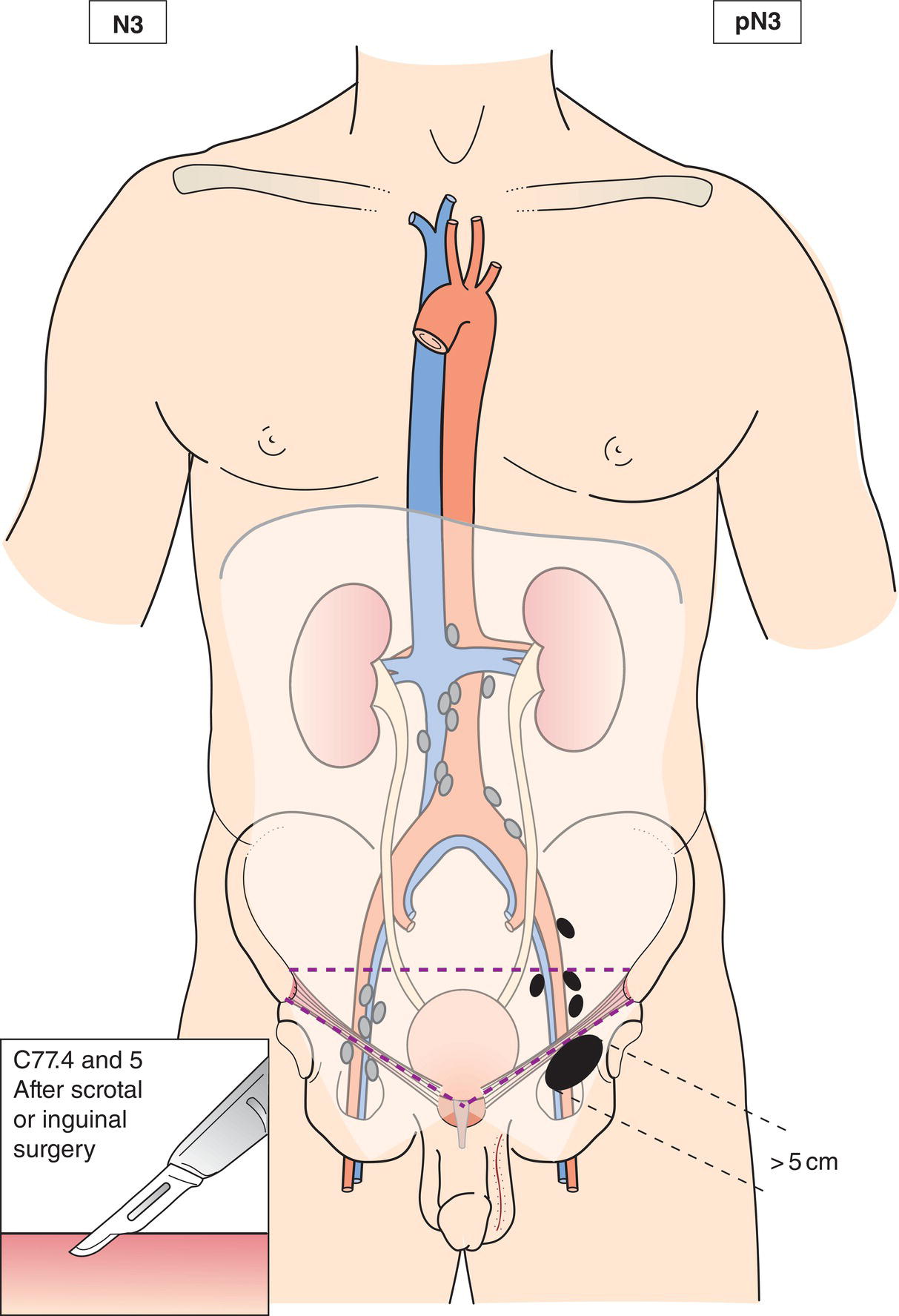 Schematic illustration of Metastasis with a lymph node mass more than 5 cm in greatest dimension.