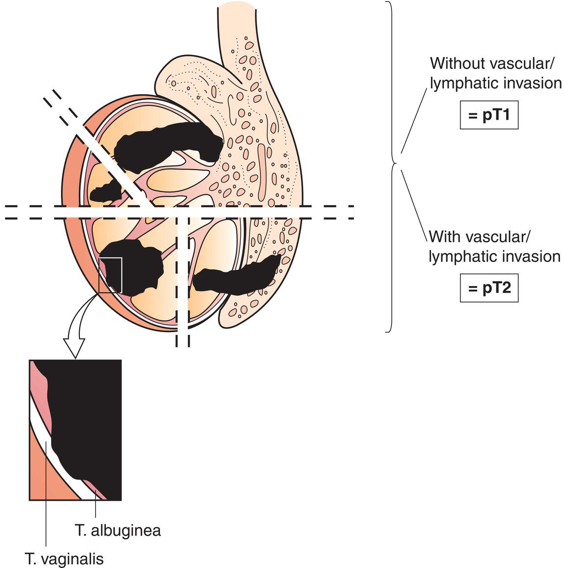 Schematic illustration of tumour limited to testis and epididymis without vascular/lymphatic invasion.