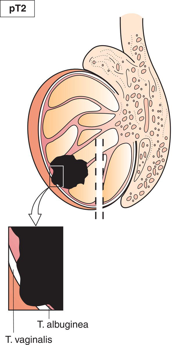 Schematic illustration of tumour extending through tunica albuginea with involvement of tunica vaginalis.