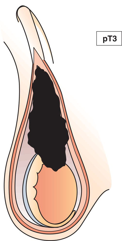 Schematic illustration of tumour invades spermatic cord with or without vascular or lymphatic invasion.