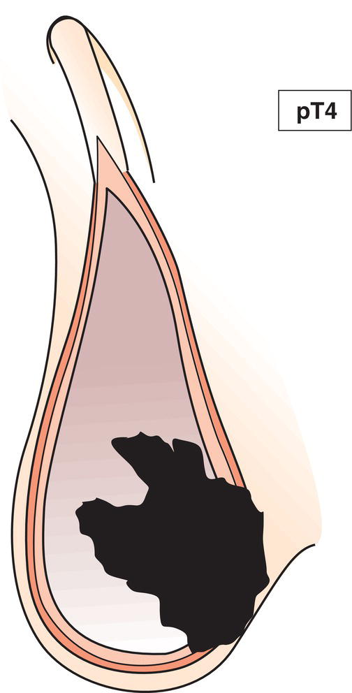 Schematic illustration of tumour invades scrotum with or without vascular or lymphatic invasion.