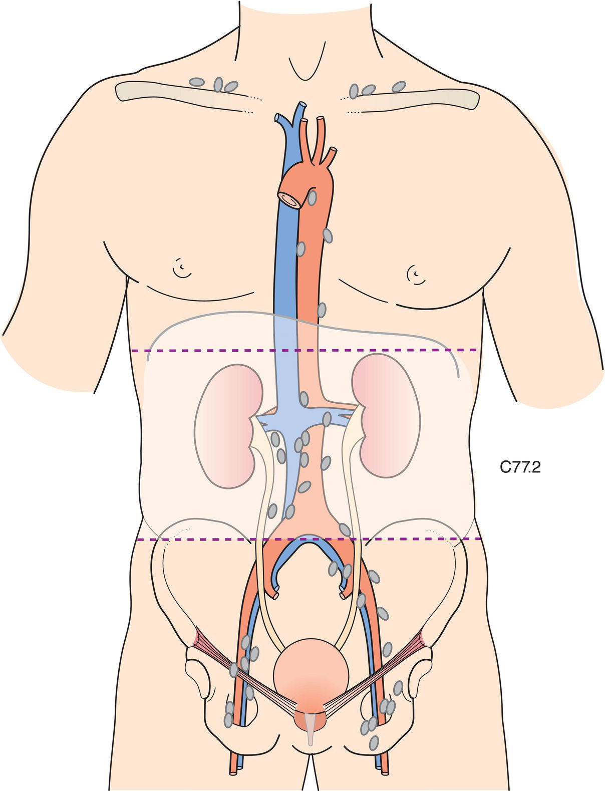 Schematic illustration of the regional lymph nodes are the hilar, abdominal para-aortic, and paracaval nodes.