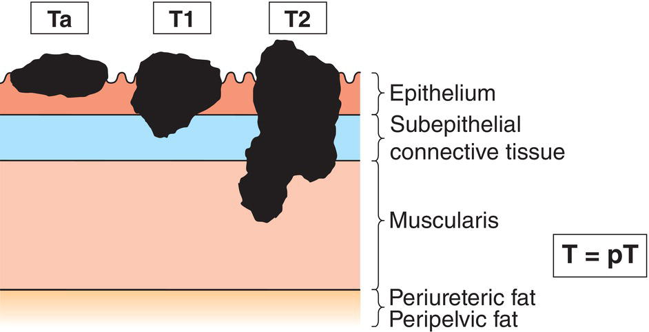 Schematic illustration of Noninvasive papillary carcinoma,Tumour invades subepithelial connective tissue, Tumour invades muscularis.