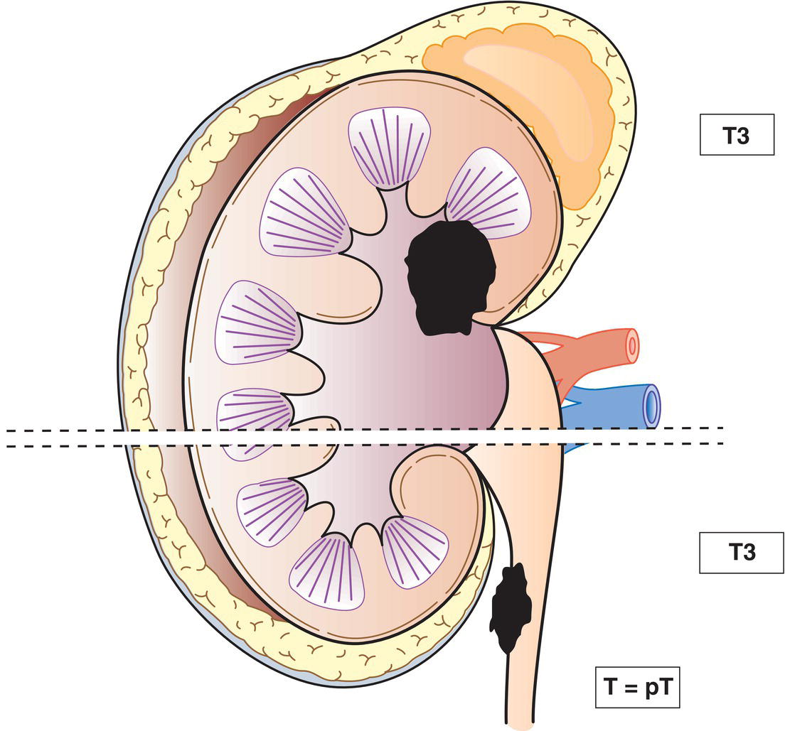 Schematic illustration of (Renal pelvis) Tumour invades beyond muscularis into peripelvic fat or renal parenchyma, (Ureter) Tumour invades beyond muscularis into periureteric fat.