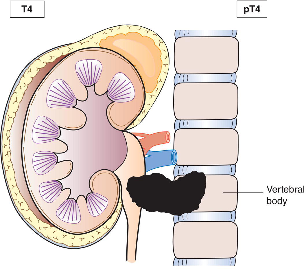 Schematic illustration of tumour invades adjacent organs.