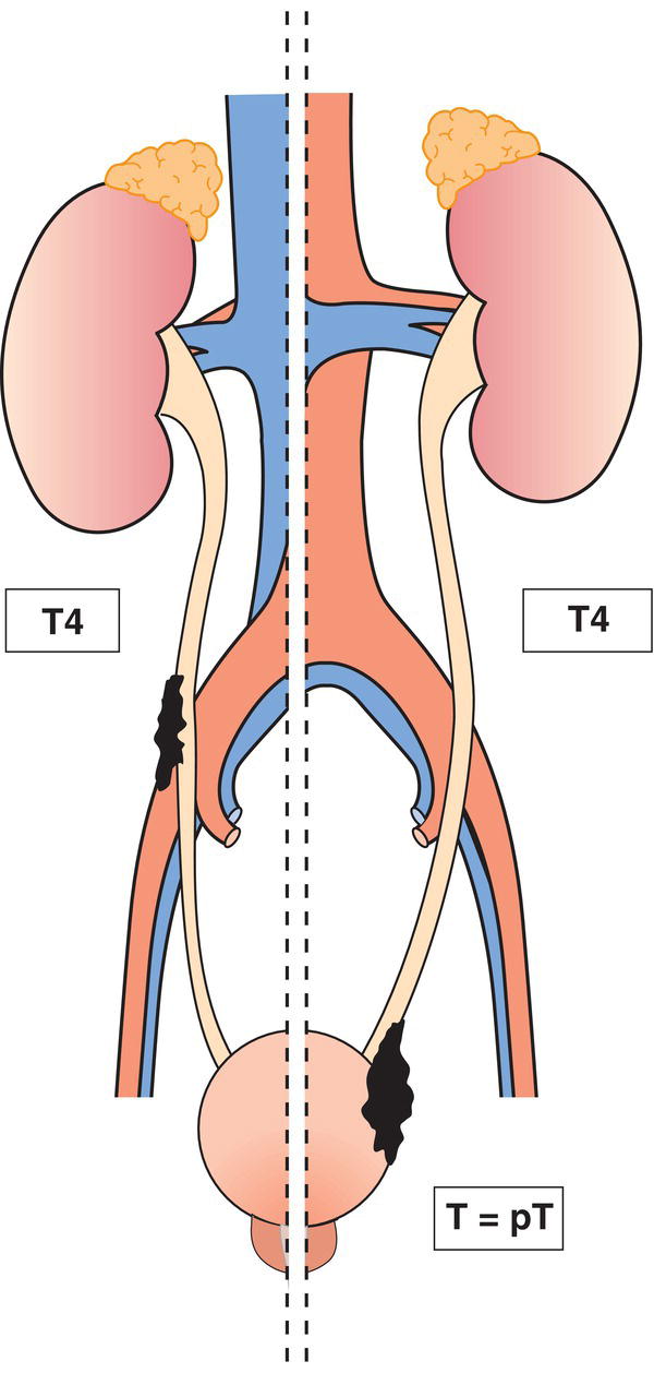 Schematic illustration of tumour invades adjacent organs.