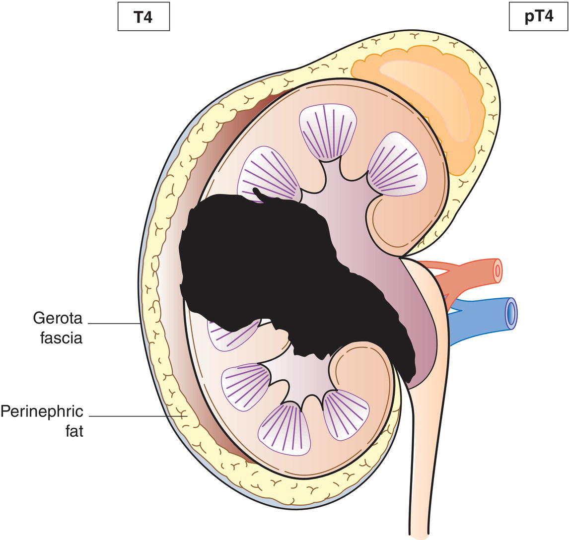 Schematic illustration of tumour invades through the kidney into
perinephric fat.