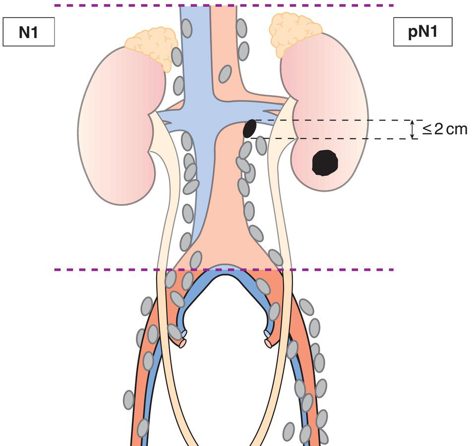 Schematic illustration of Metastasis in a single lymph node 2 cm or less in greatest dimension.